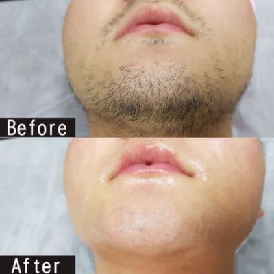 Permanent Beard Removal Cream,permanent beard hair removal cream