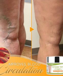 Organic Healing Cream for Varicose Vein,Varicose Vein,Organic Healing Cream,Healing Cream