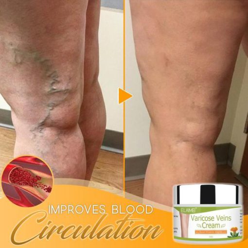 Organic Healing Cream for Varicose Vein,Varicose Vein,Organic Healing Cream,Healing Cream