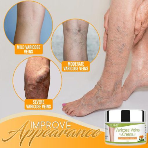 Organic Healing Cream for Varicose Vein,Varicose Vein,Organic Healing Cream,Healing Cream