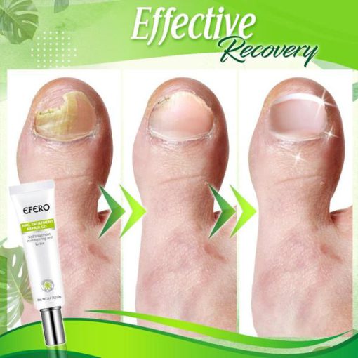 Toe Regeneration Beauty Gel,Regeneration Beauty Gel,Beauty Gel