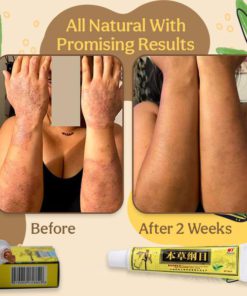 Organic Dermatitis Herbal Healing Cream,Dermatitis Herbal Healing Cream,Herbal Healing Cream,Healing Cream,Dermatitis Herbal Healing