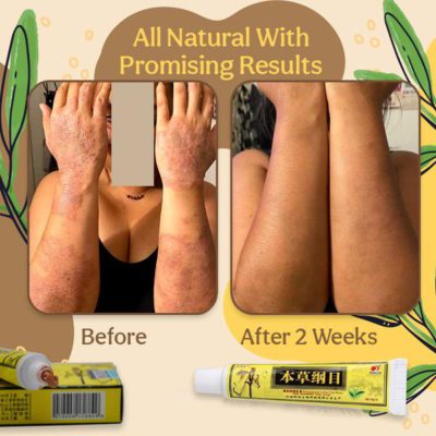 Organic Dermatitis Herbal Healing Cream,Dermatitis Herbal Healing Cream,Herbal Healing Cream,Healing Cream,Dermatitis Herbal Healing