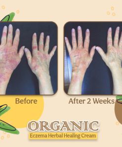 Organic Dermatitis Herbal Healing Cream,Dermatitis Herbal Healing Cream,Herbal Healing Cream,Healing Cream,Dermatitis Herbal Healing