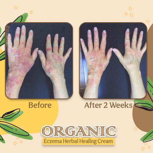 Organic Dermatitis Herbal Healing Cream,Dermatitis Herbal Healing Cream,Herbal Healing Cream,Healing Cream,Dermatitis Herbal Healing