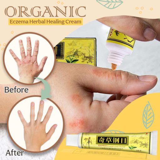 Organic Dermatitis Herbal Healing Cream,Dermatitis Herbal Healing Cream,Herbal Healing Cream,Healing Cream,Dermatitis Herbal Healing