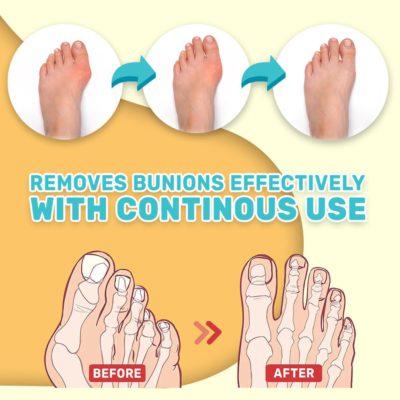 Relief Cream,Bunion Toe,Bunion Toe Stiffness Relief Cream