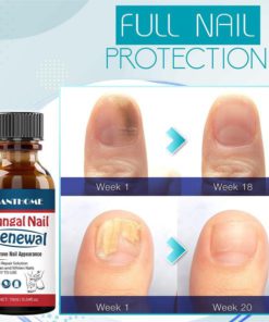 Fungal Nail Renewal Gel,Nail Renewal Gel,Fungal Nail Renewal