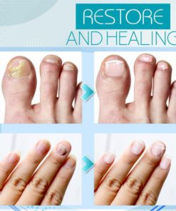 Fungal Nail Renewal Gel,Nail Renewal Gel,Fungal Nail Renewal