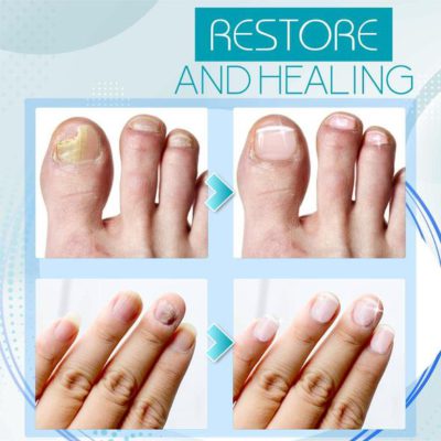 Fungal Nail Renewal Gel,Nail Renewal Gel,Fungal Nail Renewal