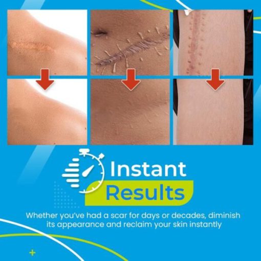 Gel Patch,Scar Removal Gel,Removal Gel,Scar Removal,Scar Removal Gel Patch