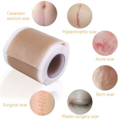 Gel Patch,Scar Removal Gel,Removal Gel,Scar Removal,Scar Removal Gel Patch