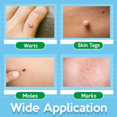 Skin Tag Remover,TagOff™ Skin Tag Remover