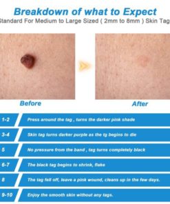 Skin Tag Removal Kit