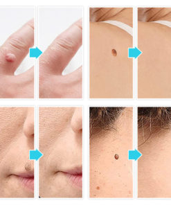 Micro Skin Tag Remover