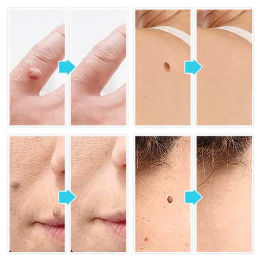 Micro Skin Tag Remover