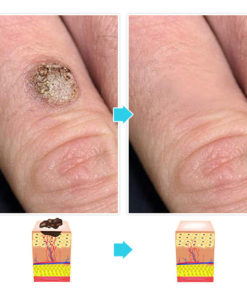 Micro Skin Tag Remover