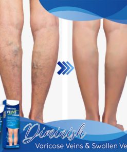 Varicose Veins Cream