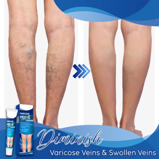 Varicose Veins Cream