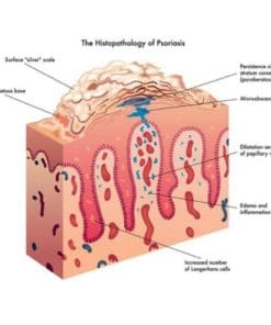 Skin Care Bacidin Psoriasis Cream