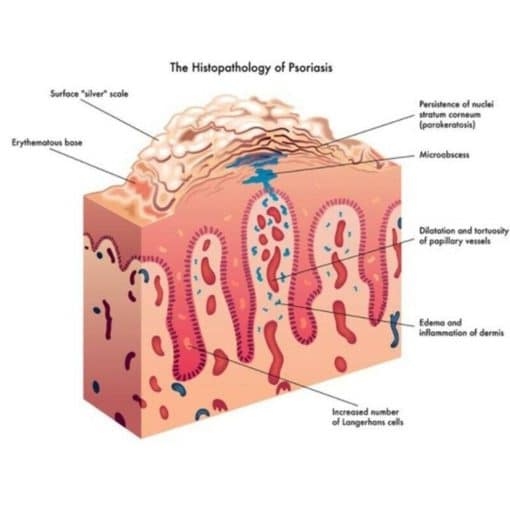 Skin Care Bacidin Psoriasis Cream