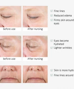 Ionic Eye Contouring System