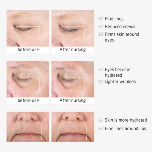 Ionic Eye Contouring System