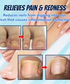 Ingrown Toenail Correction Patch