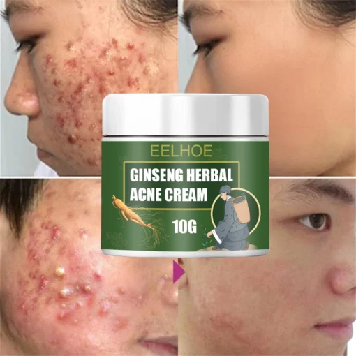 Ginseng Herbal Acne Cream