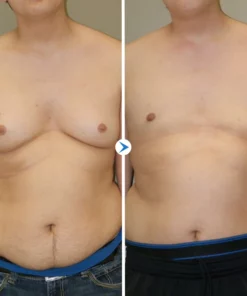 Gyno Out Chest Tightening Spray