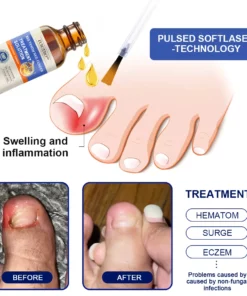 Furzero™ Bee Venom Nail Folliculitis Treatment Program