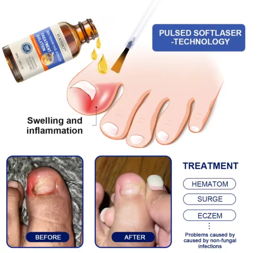 Furzero™ Bee Venom Nail Folliculitis Treatment Program