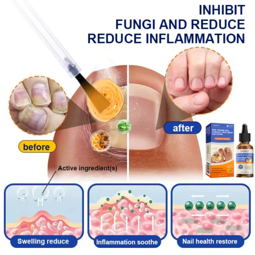 Furzero™ Bee Venom Nail Folliculitis Treatment Program