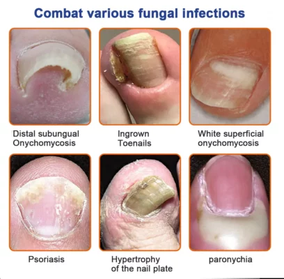 Furzero™ Bee Venom Nail Folliculitis Treatment Program