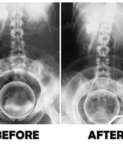 Oveallgo™ ProstaNasal Boost Portable Device