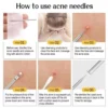 11Pcs Blackhead Needle