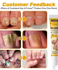 CVREOZ™ Bee Venom Nail Fungus Psoriasis Treatment Cream