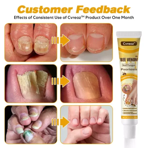 CVREOZ™ Bee Venom Nail Fungus Psoriasis Treatment Cream