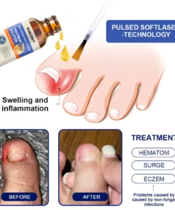 KUBOZN™ Bee Venom Nail Fungus Treatment Solution