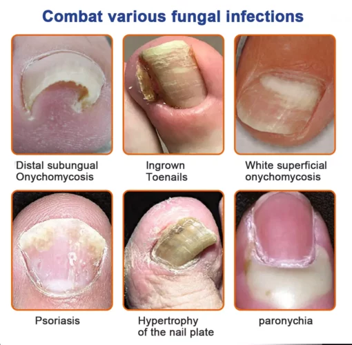 KUBOZN™ Bee Venom Nail Fungus Treatment Solution