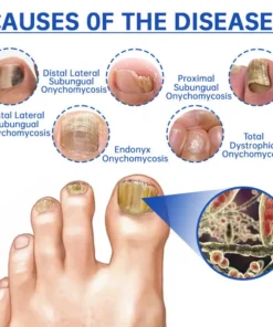 QIAWI™ PureNail Fungus Laser Device