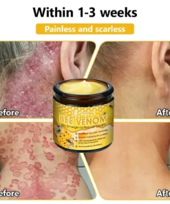 Tnnedey™ Bee Venom Skin Emergency Rescue Cream